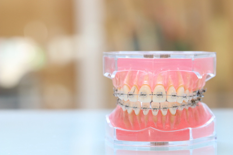 歯列模型